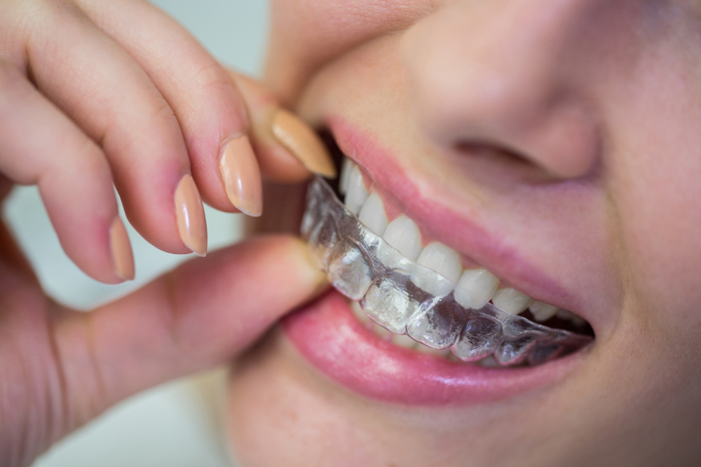 Aligners: Everything You Need to Know About Clear Dental Aligners