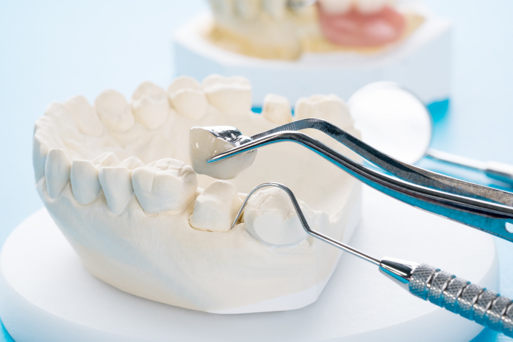 When Do You Need a Dental Crown? Everything You Should Know