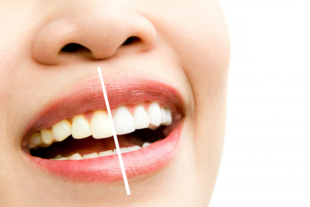 Understanding Dental Veneers: Benefits, Procedure, and Aftercare